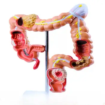 ПВХ Патология толстой кишки человека, Модель Колонологического рака прямой кишки, Медицинские Обучающие модели